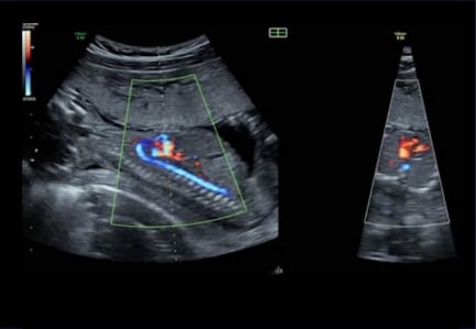 胎児超音波検査